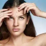Kenali Tips Mengatasi Masalah Jerawat saat Masa Remaja