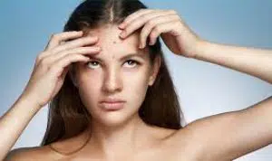 Kenali Tips Mengatasi Masalah Jerawat saat Masa Remaja