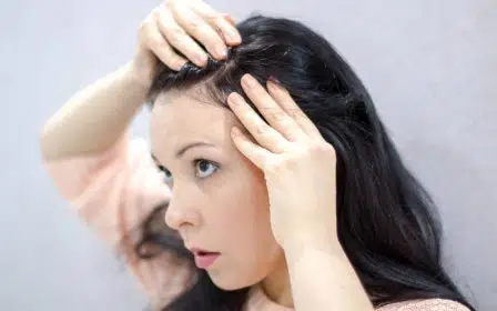Muncul Jerawat di Kulit Kepala Ini Penyebab dan 9 Cara Atasinya