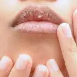 Waspada! 5 Masalah Kesehatan saat Bibir Anda Pecah-pecah