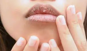 Waspada! 5 Masalah Kesehatan saat Bibir Anda Pecah-pecah