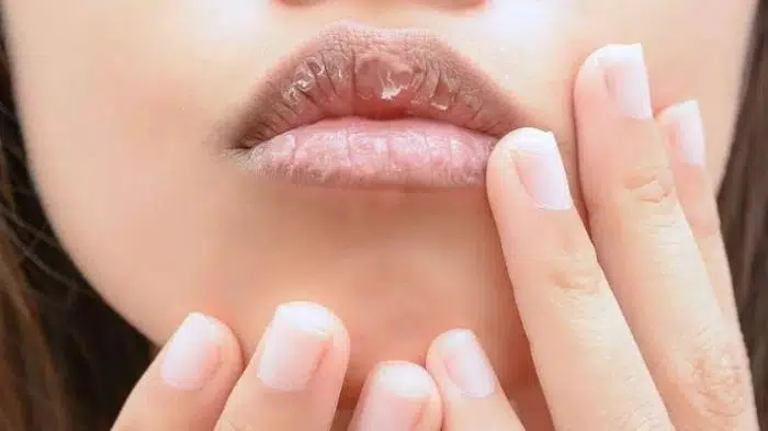 Waspada! 5 Masalah Kesehatan saat Bibir Anda Pecah-pecah