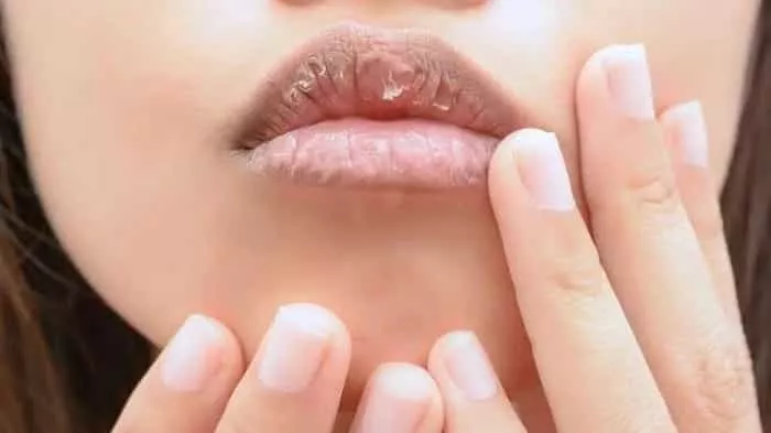 Waspada! 5 Masalah Kesehatan saat Bibir Anda Pecah-pecah