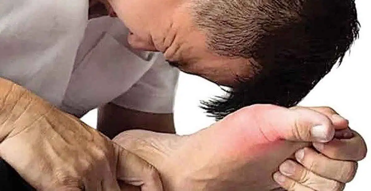 obat asam urat alami