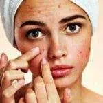 Jangan Dipencet! 4 Bahan Alami Ini yang Ampuh Obati Jerawat yang Membandel