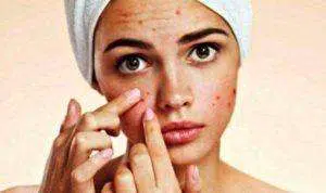 Jangan Dipencet! 4 Bahan Alami Ini yang Ampuh Obati Jerawat yang Membandel