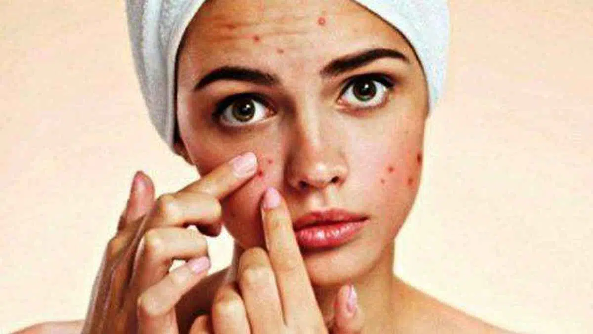 Jangan Dipencet! 4 Bahan Alami Ini yang Ampuh Obati Jerawat yang Membandel