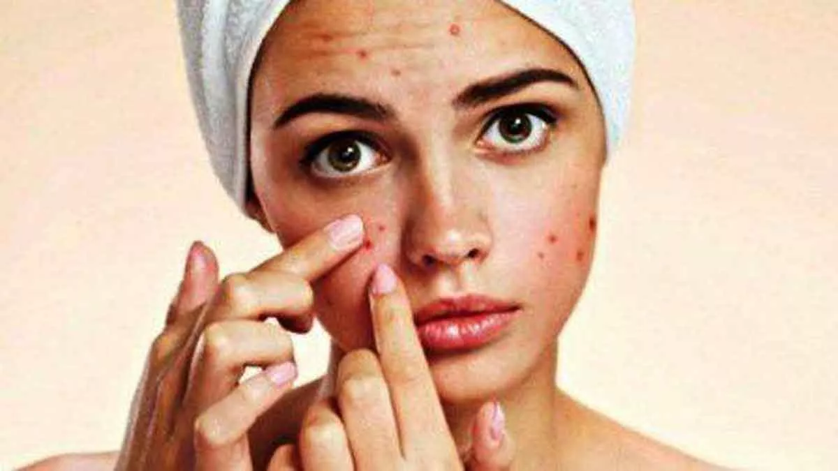 Jangan Dipencet! 4 Bahan Alami Ini yang Ampuh Obati Jerawat yang Membandel