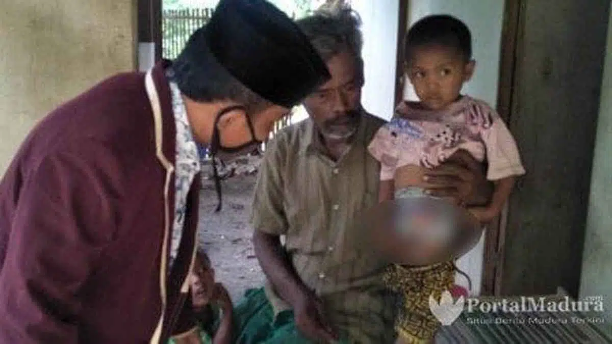 Bocah 6 Tahun Tanpa Anus, Hidup Bersama Ayahnya di Gubuk Bambu