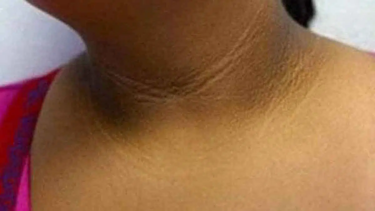 5 Bahan Alami Cegah Leher Hitam Saat Anda Hamil