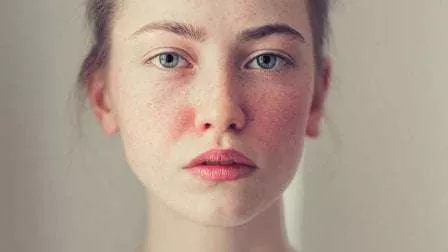 Menakjubkan 3 Bahan Alami Dapat Atasi Rosacea