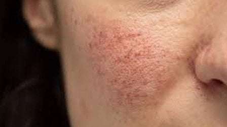 Ketahui Jenis - Jenis dan Gejala Rosacea