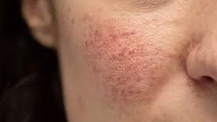 Ketahui Jenis - Jenis dan Gejala Rosacea