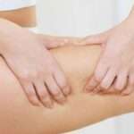 5 Cara Atasi Stretch Mark Pada Daerah Paha