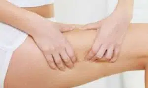 5 Cara Atasi Stretch Mark Pada Daerah Paha