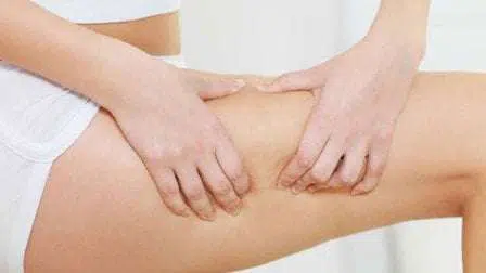 5 Cara Atasi Stretch Mark Pada Daerah Paha
