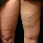 Kenali 3 Cara Samarkan Selulit di Tubuh Anda