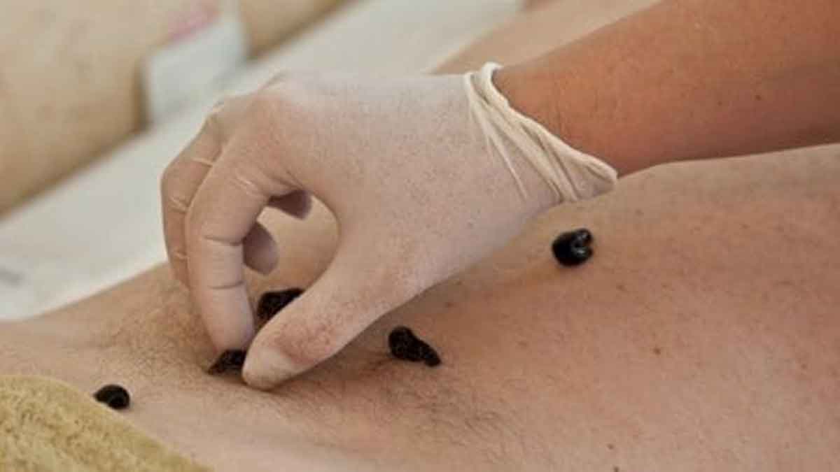 Manfaat Terapi Lintah untuk Kesehatan