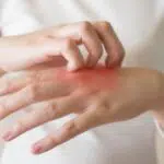 Berikut Cara Menghilangkan Jamur Kulit dengan Bumbu Dapur