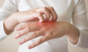 Berikut Cara Menghilangkan Jamur Kulit dengan Bumbu Dapur