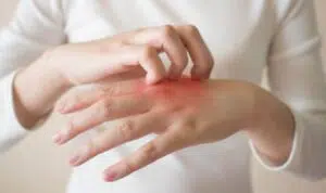Berikut Cara Menghilangkan Jamur Kulit dengan Bumbu Dapur