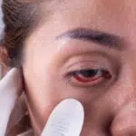 Berikut Penyebab Cedera Mata yang Wajib Anda Hindari
