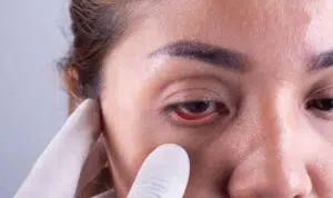 Berikut Penyebab Cedera Mata yang Wajib Anda Hindari