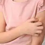 Ketahui 4 Cara Mengatasi Biduran pada Anak
