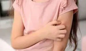 Ketahui 4 Cara Mengatasi Biduran pada Anak