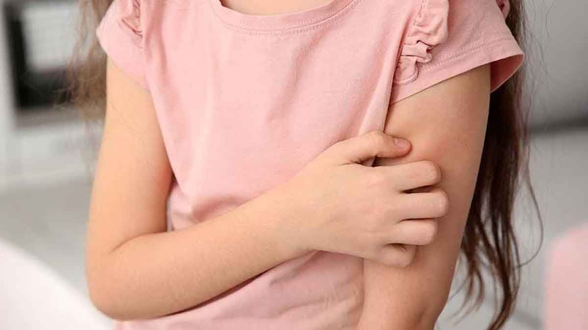 Ketahui 4 Cara Mengatasi Biduran pada Anak