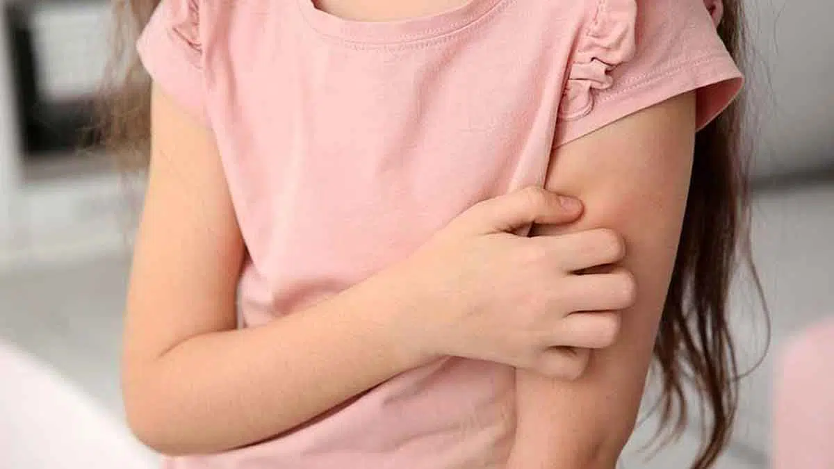 Ketahui 4 Cara Mengatasi Biduran pada Anak