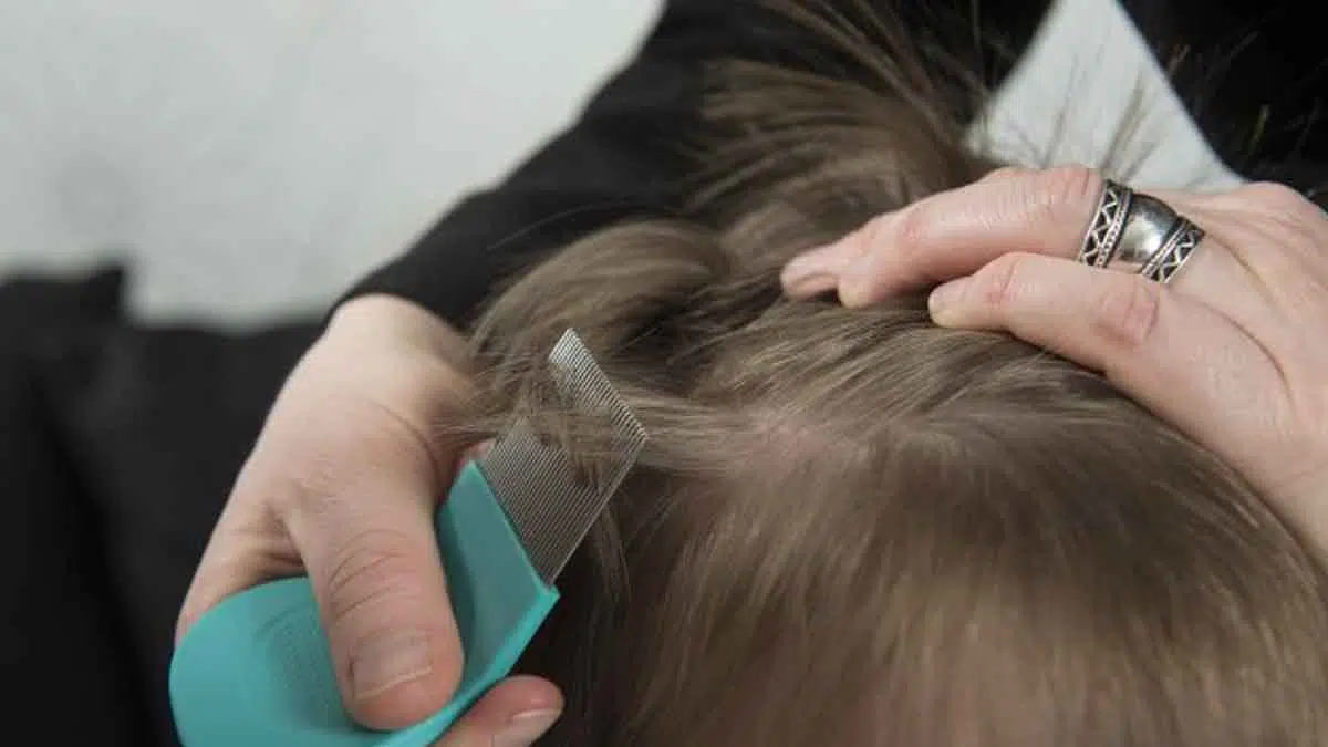 3 Cara Menghilangkan Kutu Rambut yang Bisa Dilakukan di Rumah