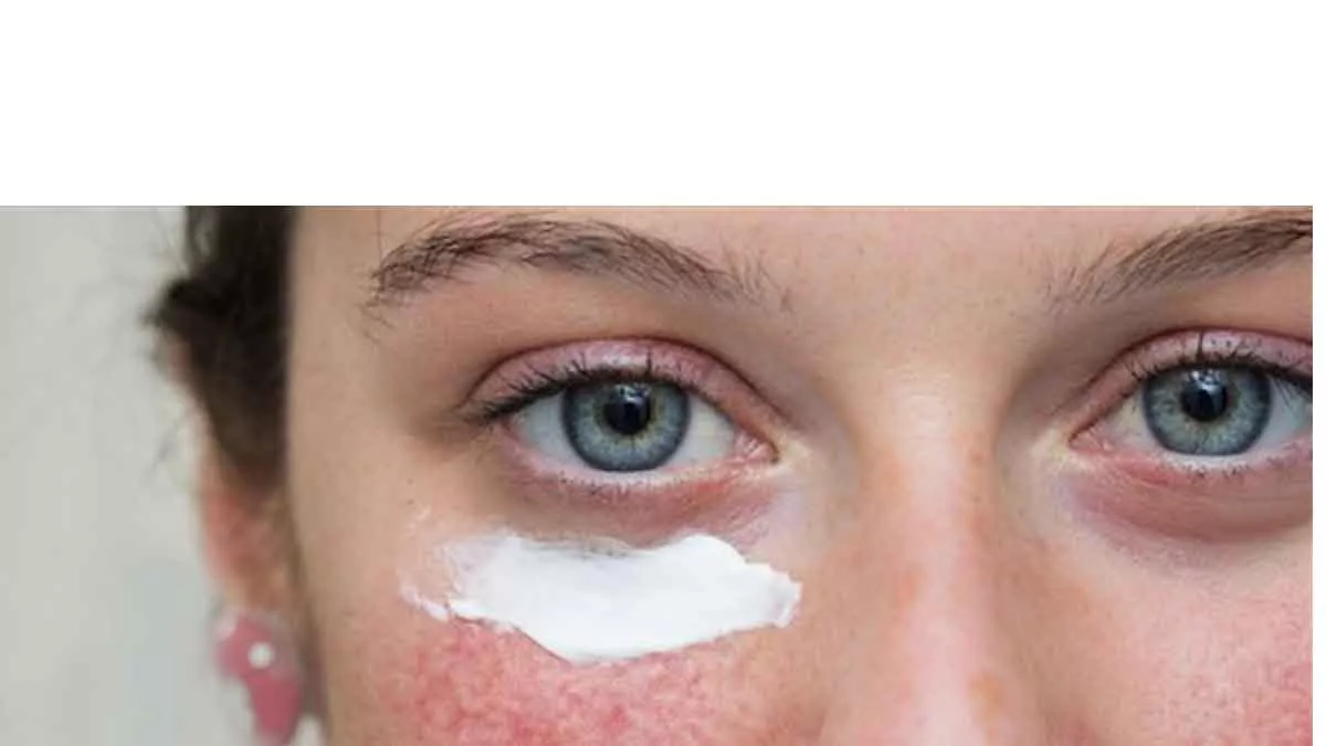 Jangan Sembarangan! Ini 4 Cara Rawat Kulit Sensitif dan Rosacea