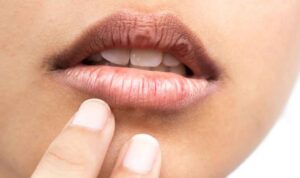5 Cara Mudah Atasi Bibir Kering dan Pecah-Pecah