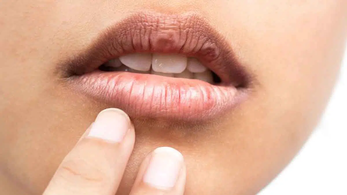 5 Cara Mudah Atasi Bibir Kering dan Pecah-Pecah