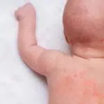 Cara Ampuh Mengatasi Biang Keringat pada Anak