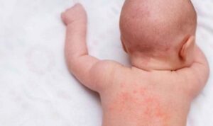 Cara Ampuh Mengatasi Biang Keringat pada Anak