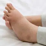 Cara Mengatasi Kaki Bengkak Setelah Melahirkan