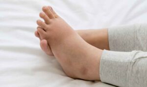 Cara Mengatasi Kaki Bengkak Setelah Melahirkan