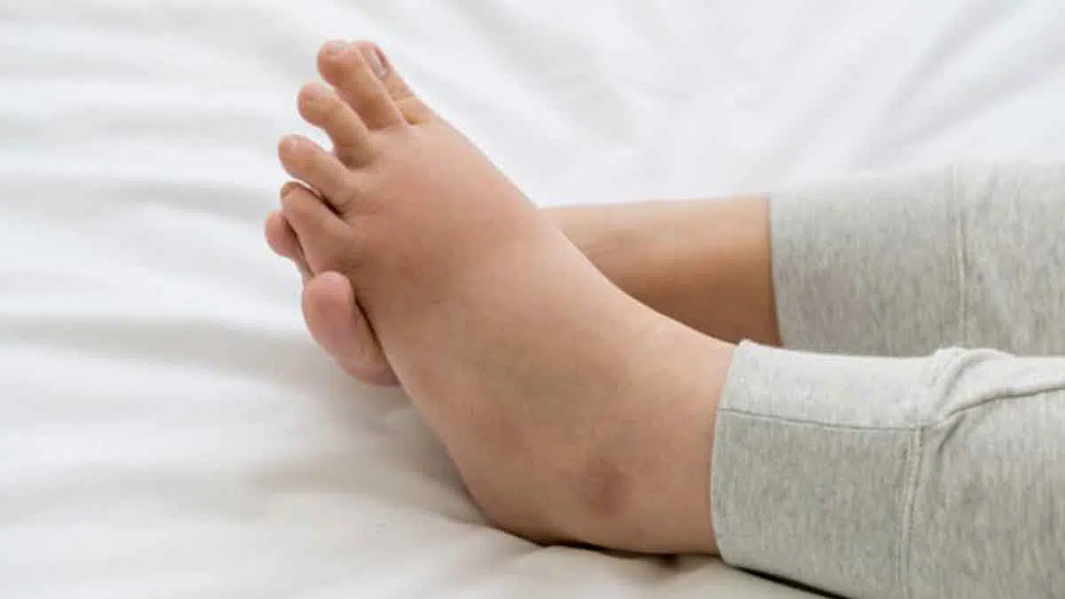Cara Mengatasi Kaki Bengkak Setelah Melahirkan