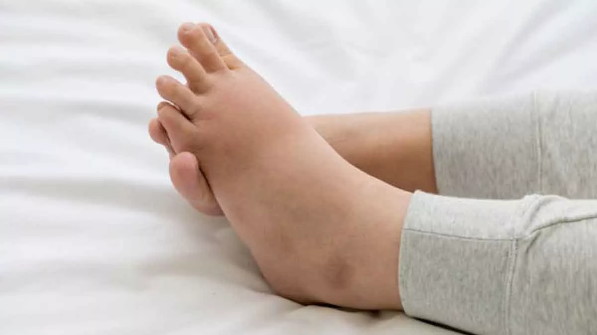 Cara Mengatasi Kaki Bengkak Setelah Melahirkan