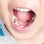 Cara Ampuh Mengatasi Gigi Berlubang pada Anak