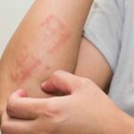 Kenali Penyebab dan Gejala Alergi Air yang Tergolomg Langka