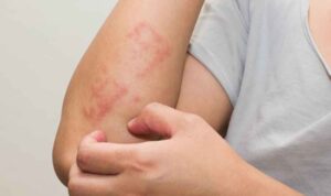 Kenali Penyebab dan Gejala Alergi Air yang Tergolomg Langka