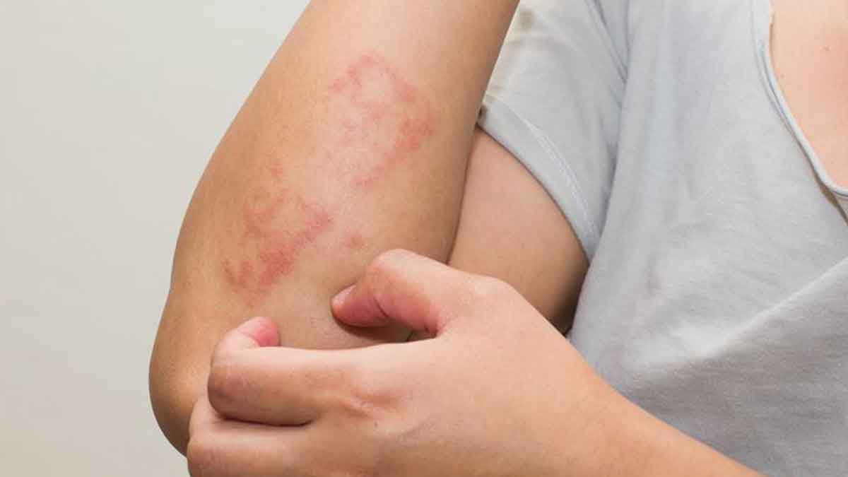 Kenali Penyebab dan Gejala Alergi Air yang Tergolomg Langka