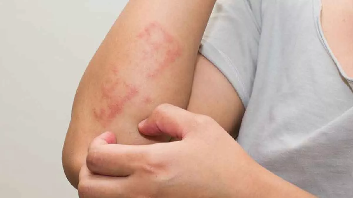 Kenali Penyebab Dan Gejala Alergi Air Yang Tergolomg Langka - Portalmadura.com Kenali Penyebab dan Gejala Alergi Air yang Tergolomg Langka