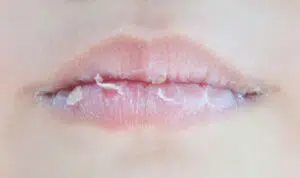 Atasi Bibir Kering dan Pecah-Pecah dengan 4 Cara Berikut