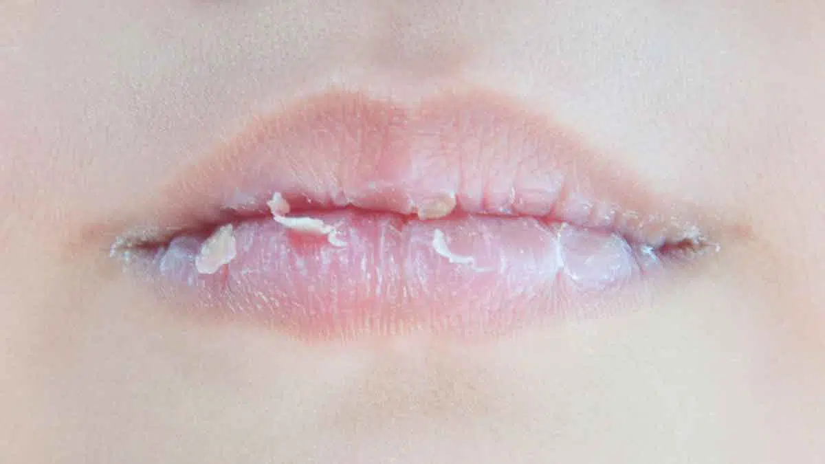 Atasi Bibir Kering dan Pecah-Pecah dengan 4 Cara Berikut