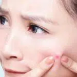 5 Cara Cegah Jerawat Saat Menjelang Menstruasi