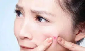 5 Cara Cegah Jerawat Saat Menjelang Menstruasi